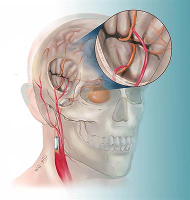 A Hybrid Strategy for Patients With Complex Cerebral Aneurysm: STA–MCA Bypass in Combination With Endovascular Embolization